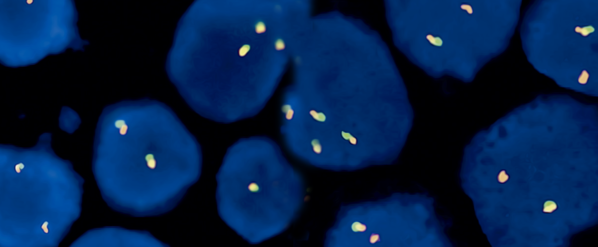 Novembro Azul – Você sabe como testes por FISH podem auxiliar nos diagnósticos de tumor de próstata?