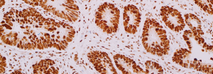 Ainda sobre câncer colorretal: Síndrome de Lynch – Conheça nosso painel para avaliação imunohistoquimica das proteínas MMR