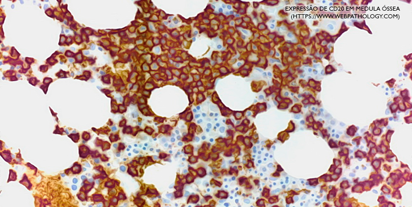 Fevereiro Laranja – Como a imunohistoquímica pode auxiliar no diagnóstico das leucemias?
